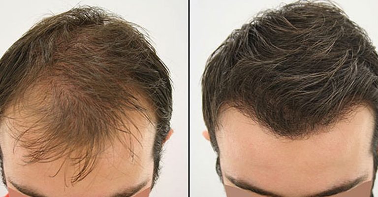 Hair Transplant for Long Hair in Turkey