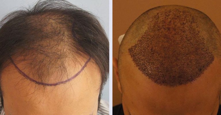 Hair Transplant Istanbul