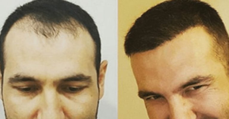 How Much is a Hair Transplant in Turkey