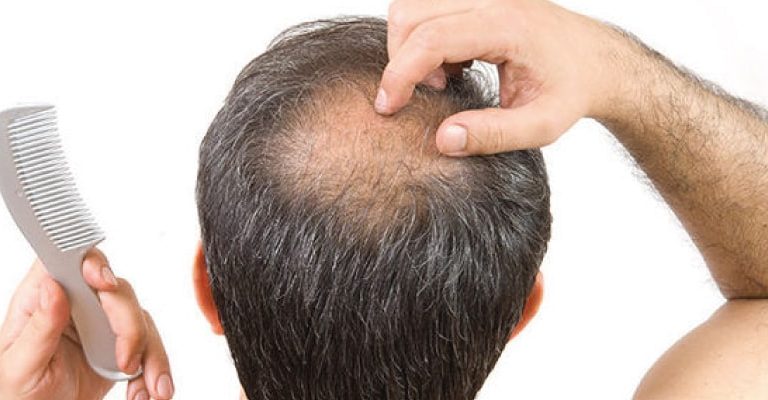 How to Stop Hair Loss in Men?