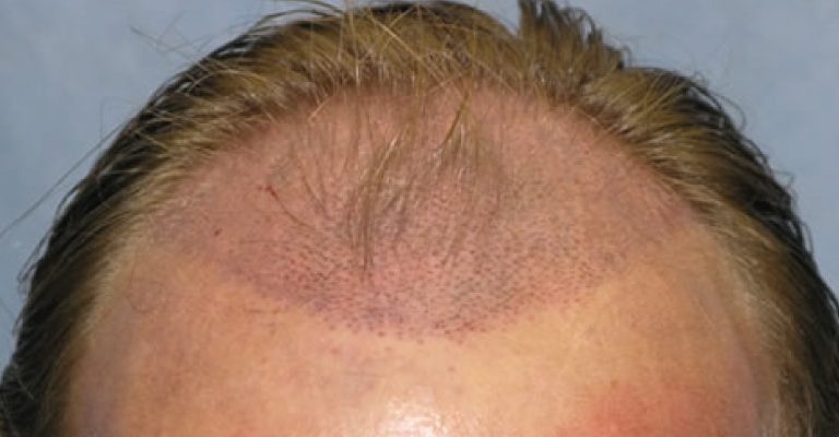 Men's Hair Transplant Surgery