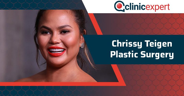 Chrissy Teigen Plastic Surgery