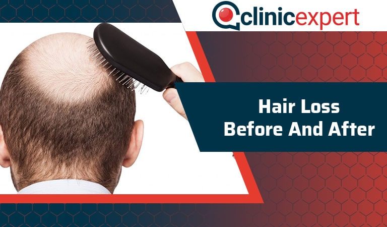 Hair Loss Before and After