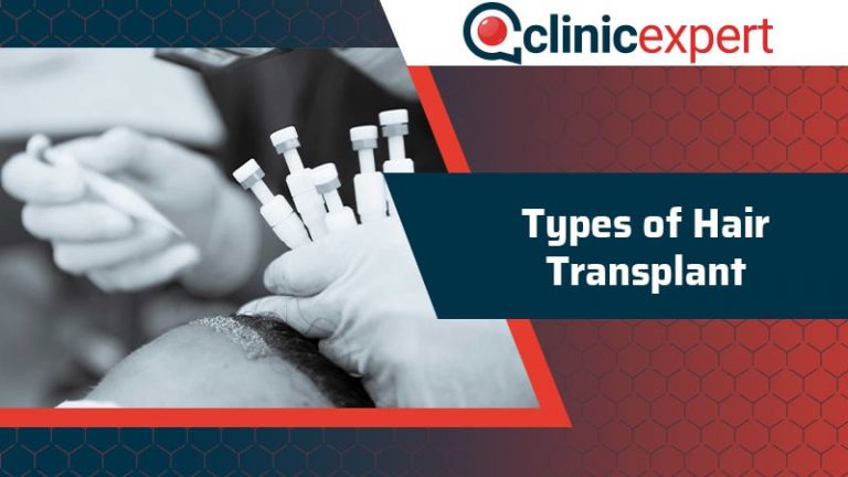 Types Of Hair Transplant Clinicexpert 4593