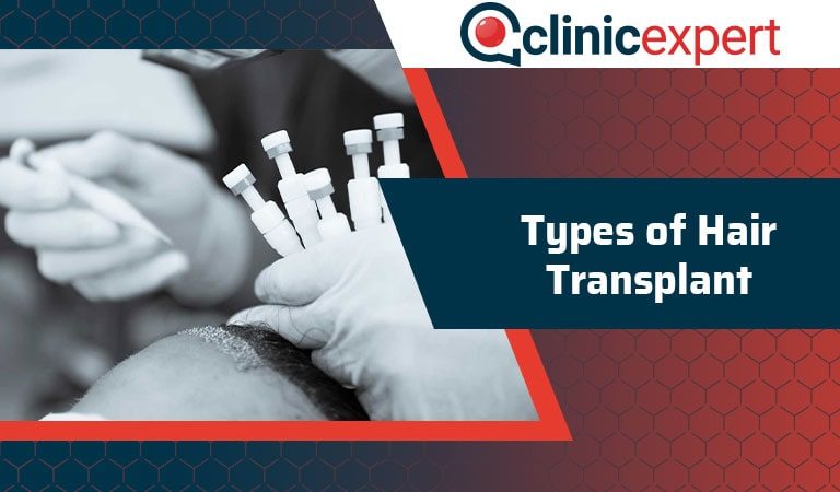 Types of Hair Transplant