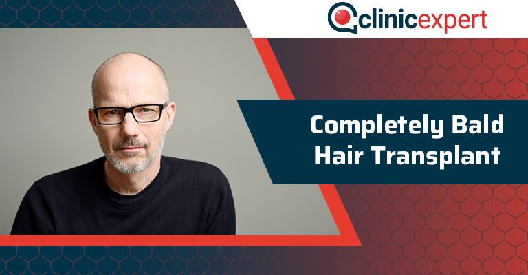 Completely Bald Hair Transplant