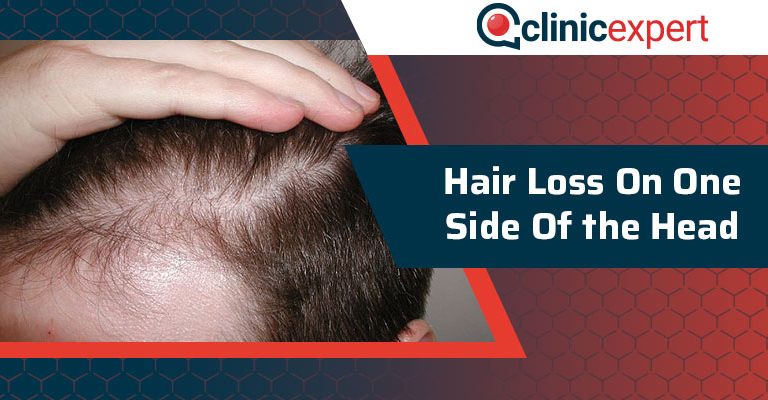 Hair Loss On One Side of the Head