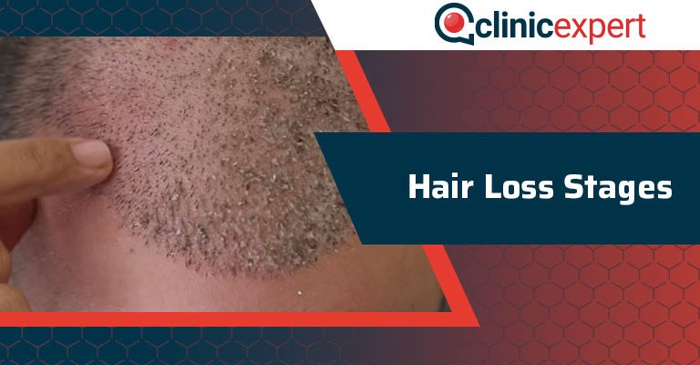 Hair Loss Stages