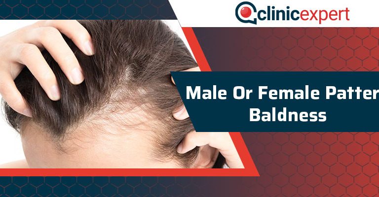 Male Or Female Pattern Baldness