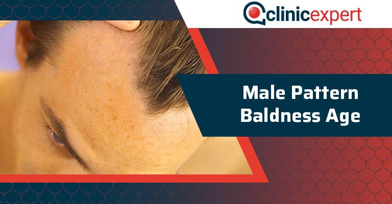 Male Pattern Baldness Age