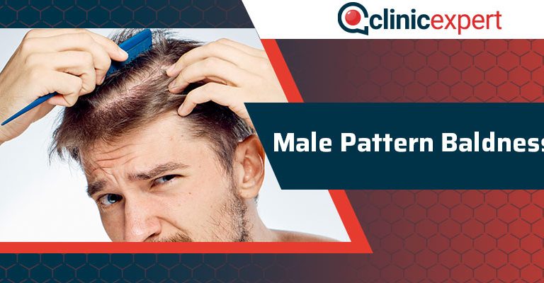 Male Pattern Baldness