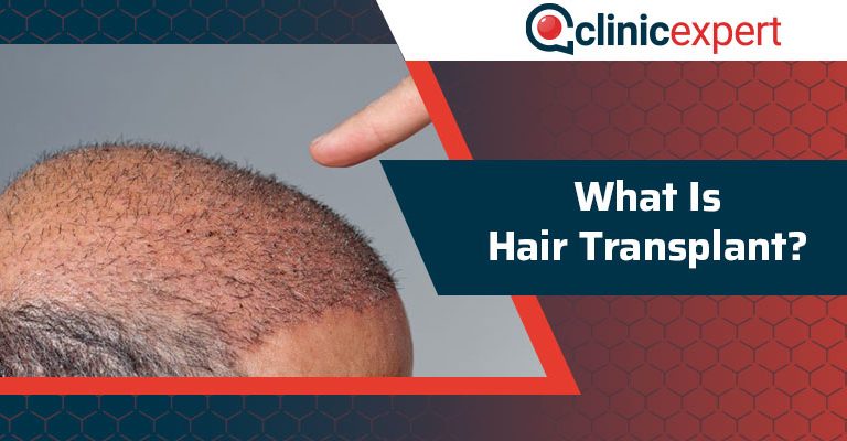 What Is Hair Transplant?