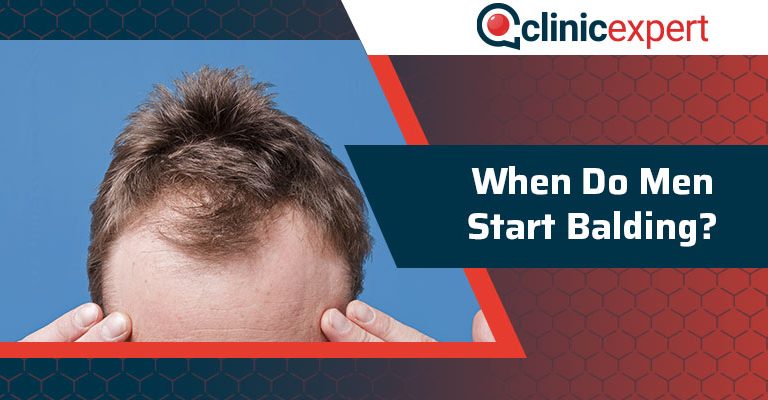 When Do Men Start Balding?