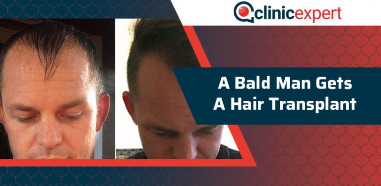 A Bald Man Gets a Hair Transplant | ClinicExpert