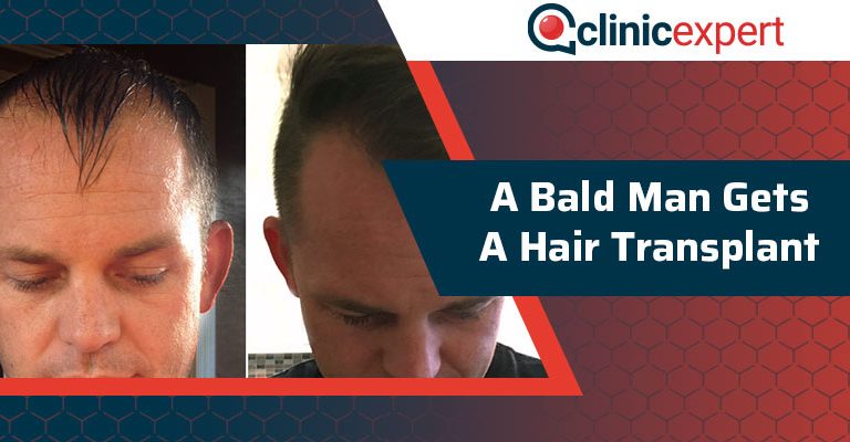 A Bald Man Gets a Hair Transplant