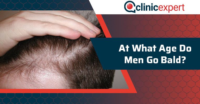 At What Age Do Men Go Bald?