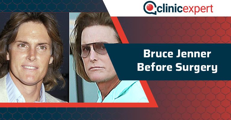 Bruce Jenner Before Surgery