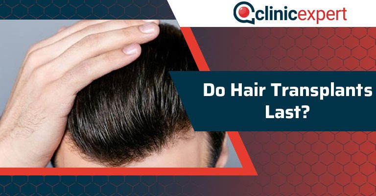 Do Hair Transplants Last?