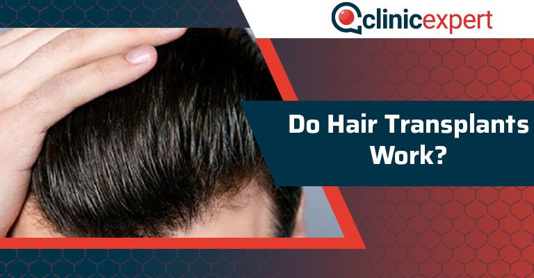 Do Hair Transplants Work?