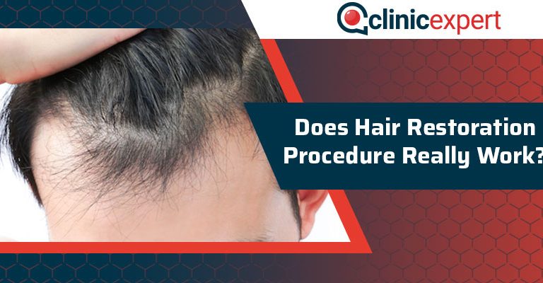 Does Hair Restoration Procedure Really Work?