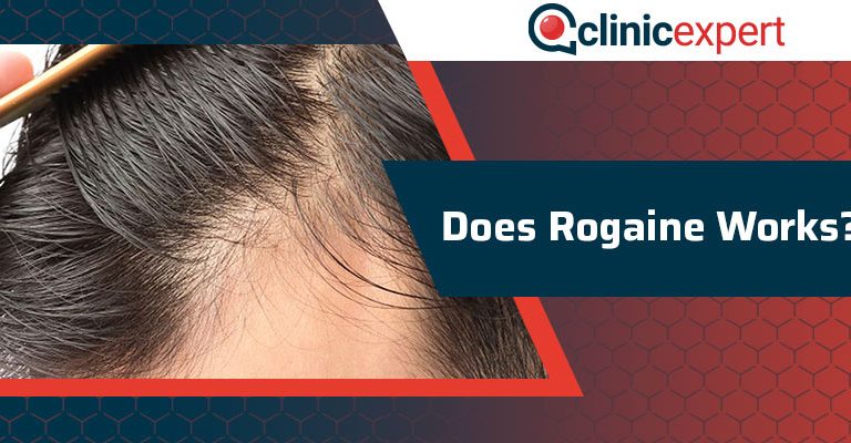 Does Rogaine Works?