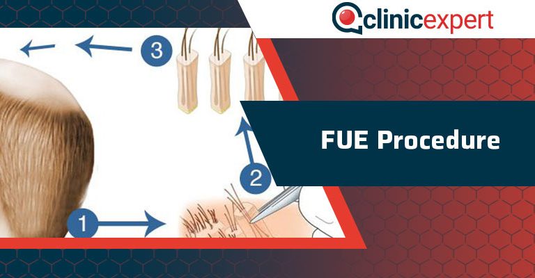 FUE Procedure