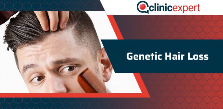 Genetic Hair Loss Clinicexpert