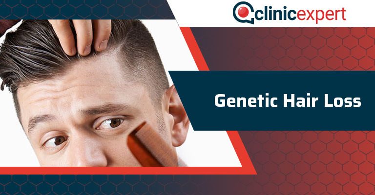 Genetic Hair Loss