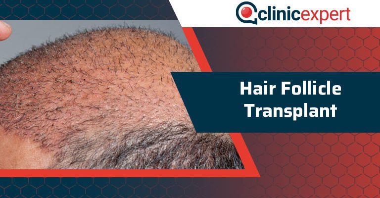 Hair Follicle Transplant