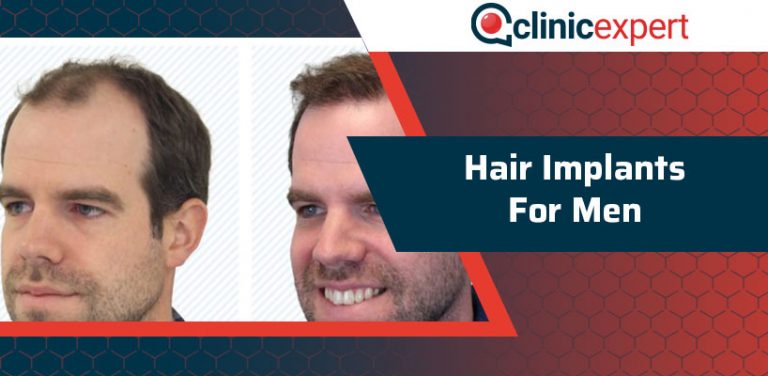 Hair Implants for Men | ClinicExpert International