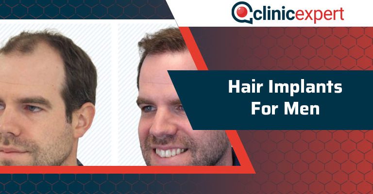 Hair Implants for Men