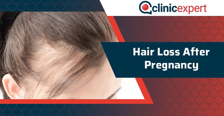 Hair Loss After Pregnancy