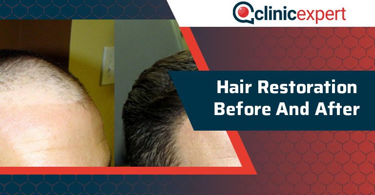 Hair Restoration Before and After