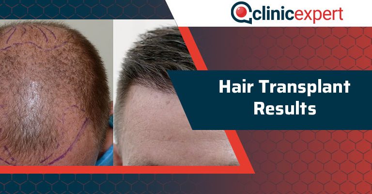 Hair Transplant Results