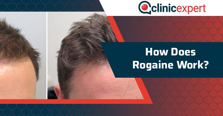 How Does Rogaine Work?