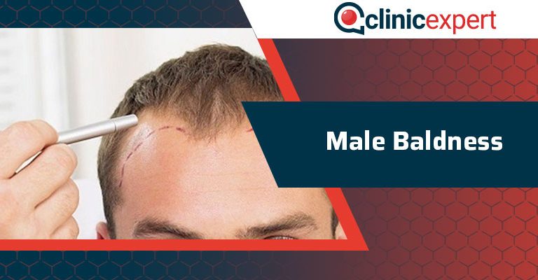 Male Baldness