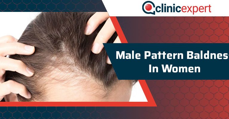 Male Pattern Baldness in Women