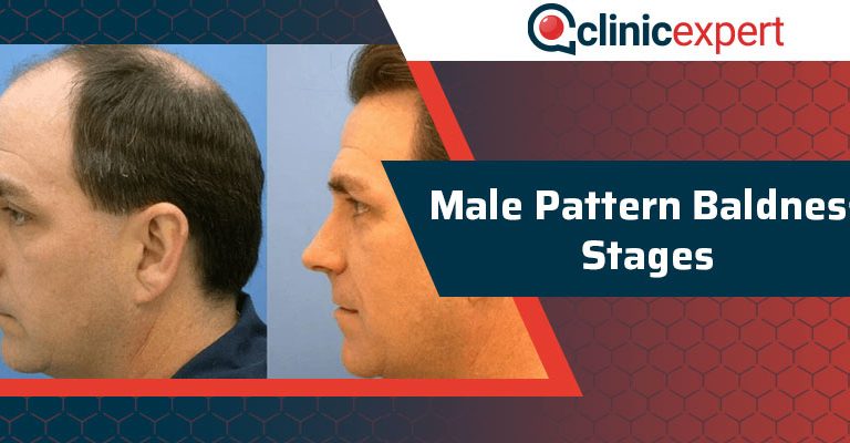 Male Pattern Baldness Stages