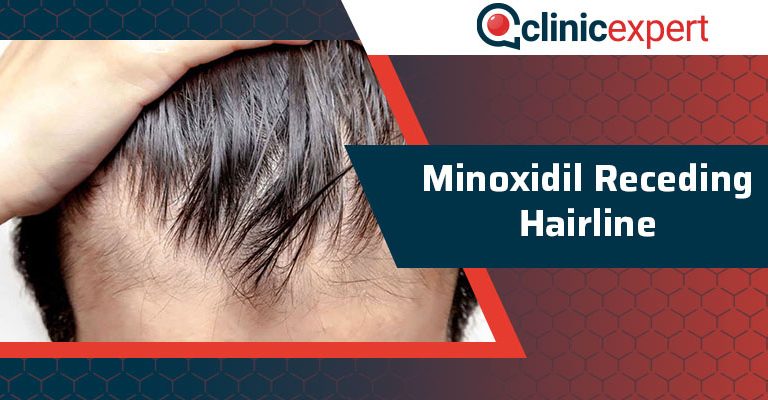 Minoxidil Receding Hairline