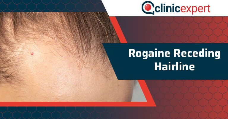 Rogaine Receding Hairline