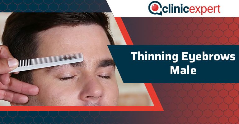 Thinning Eyebrows Male