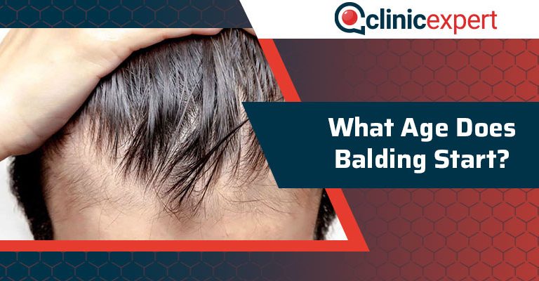 What Age Does Balding Start?