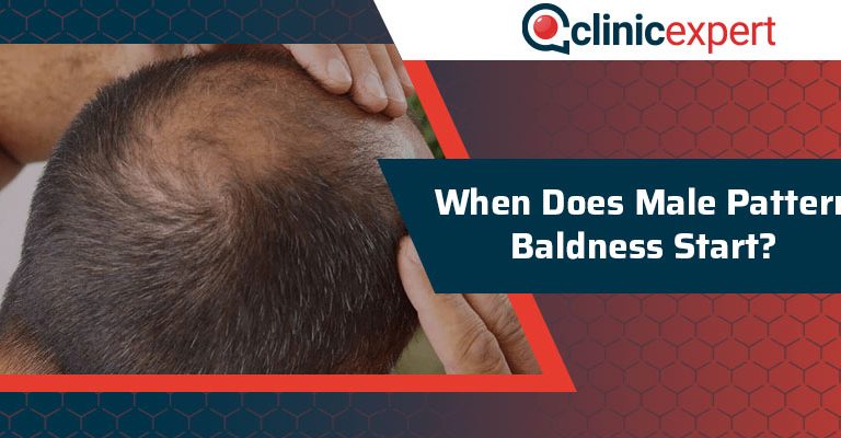 When Does Male Pattern Baldness Start?