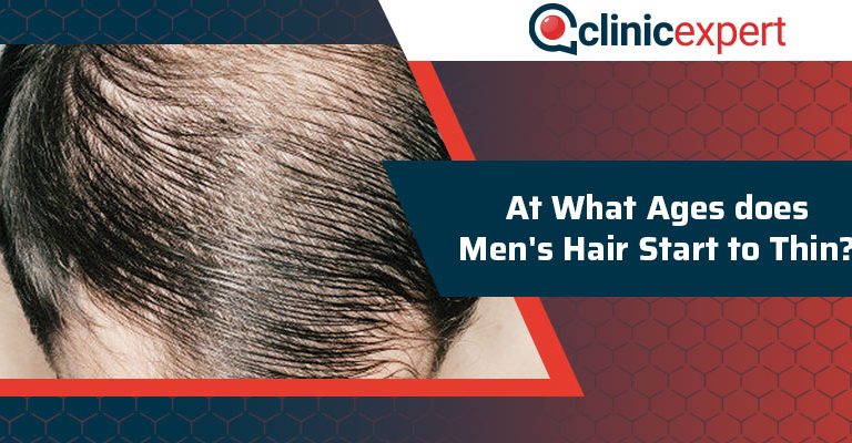 At What Ages does Men's Hair Start to Thin?