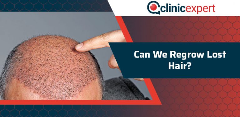 Can We Regrow Lost Hair Clinicexpert