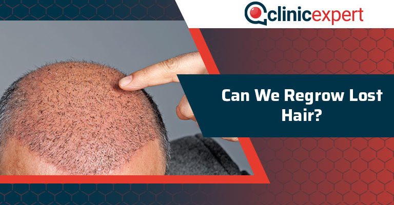 Can We Regrow Lost Hair?