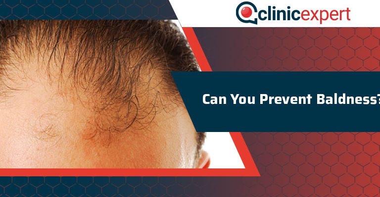 Can You Prevent Baldness From Occurring?