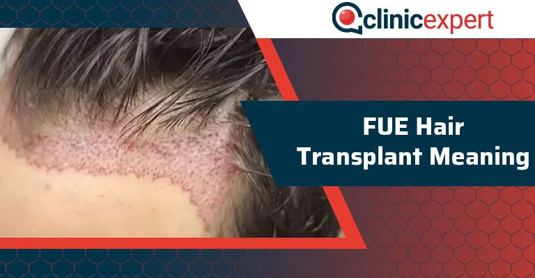 Fue Hair Transplant Meaning