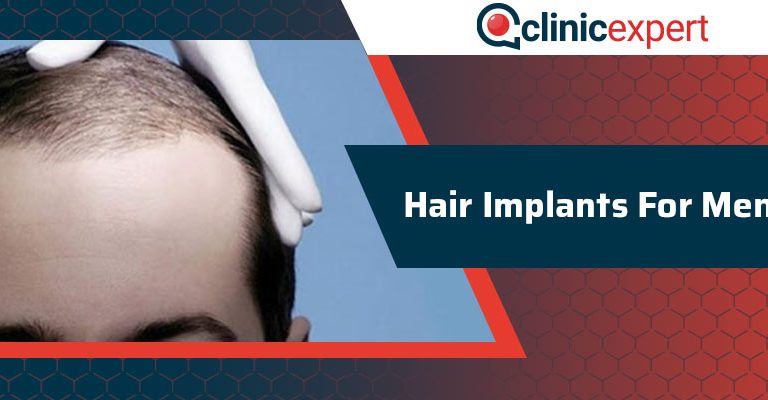 Hair Implants For Men