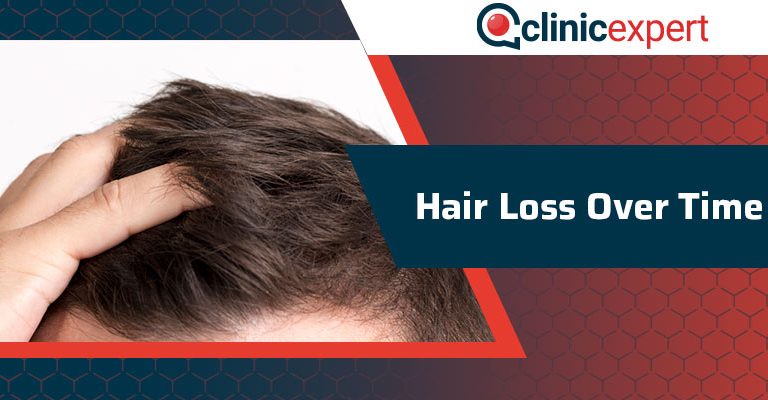 Hair Loss Over Time